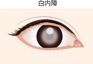 白内障