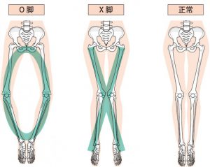 O脚とX脚の違い